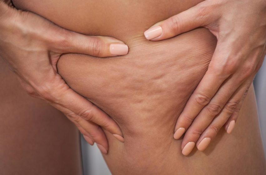  Check about cellulite causes, treatments, and other aspects