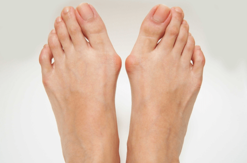 What are bunions and the Causes of bunions?