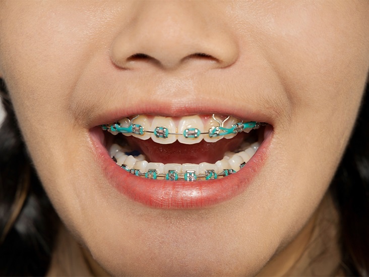 Orthodontist Treatment For A Perfect Pair Of Teeth