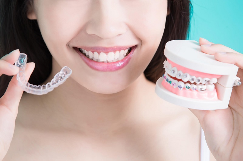  Considering Invisalign Over Traditional Braces