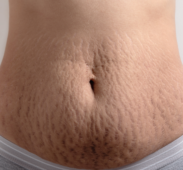  5 Ways To Treat Pregnancy Stretch Marks